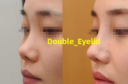double eyelid