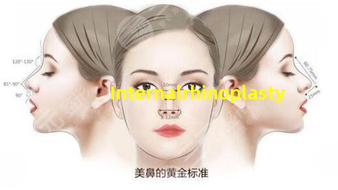 internal rhinoplasty