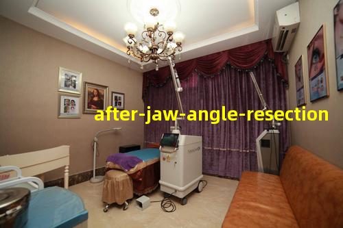 after-jaw-angle-resection