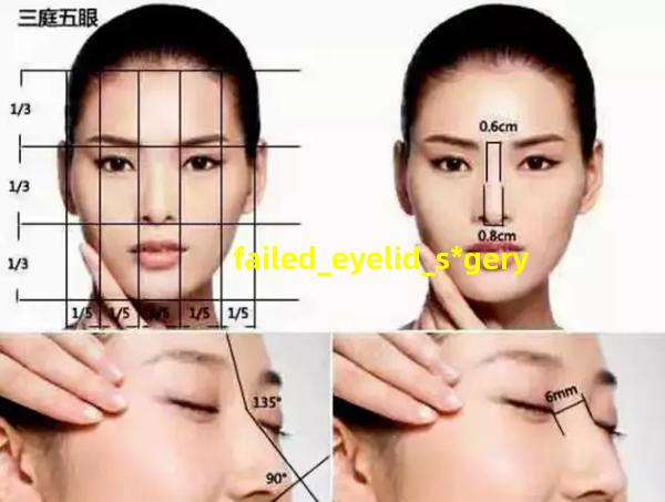 failed_eyelid_s*gery 割双眼皮失败