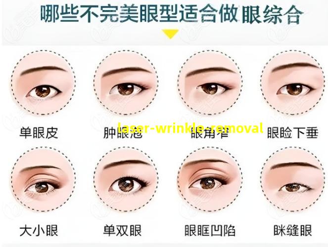 激光除皱手术效果示意图