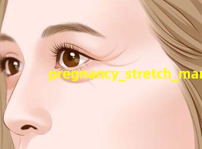 pregnancy stretch marks