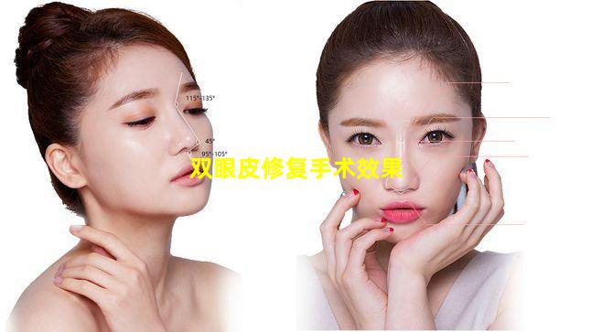双眼皮修复手术效果