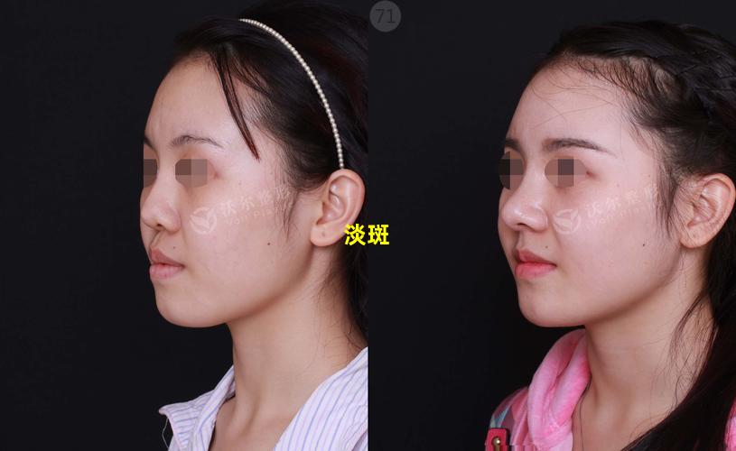 淡斑效果