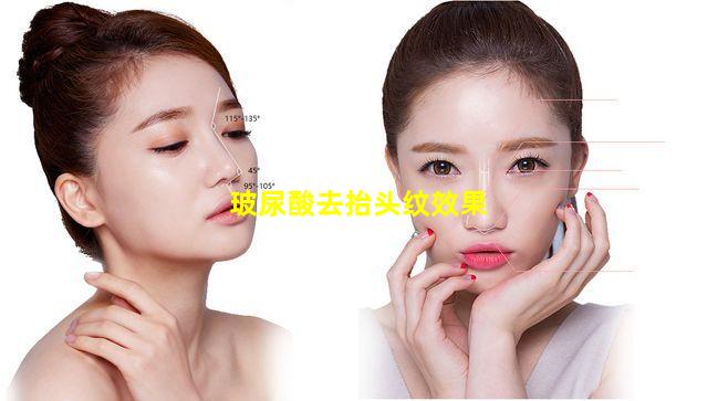 玻尿酸去抬头纹效果