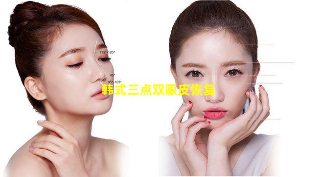 韩式三点双眼皮恢复